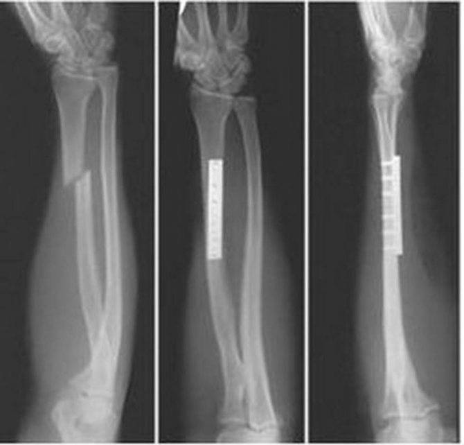 Переломы плечевой кости в месте образования локтевого сустава | компетентно о здоровье на ilive