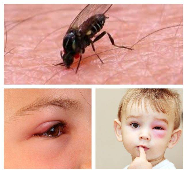 /глаз опух от укуса комара у ребенка - что делать?