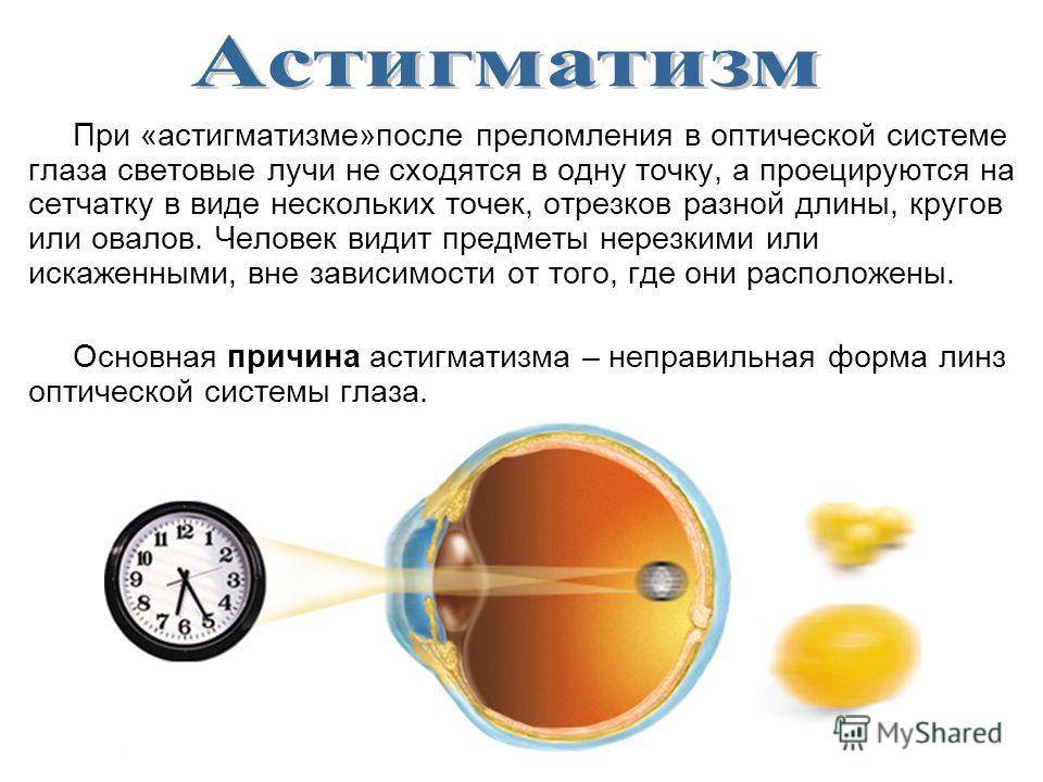 Дальнозоркий астигматизм у детей, лечение сложного дальнозоркого астигматизма в fedorovmedcenter