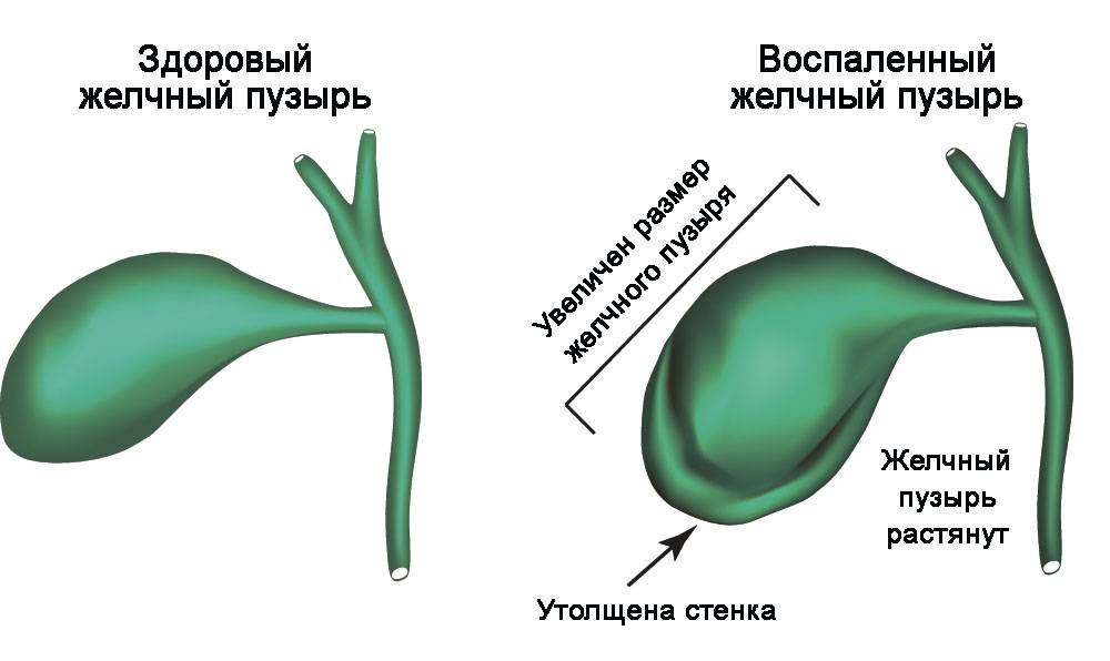 Перегиб желчного пузыря