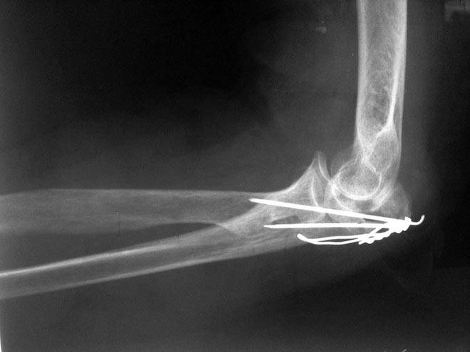 Переломы локтевого отростка локтевой кости