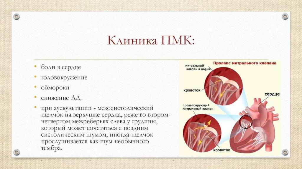 Пролапс мм митрального клапана