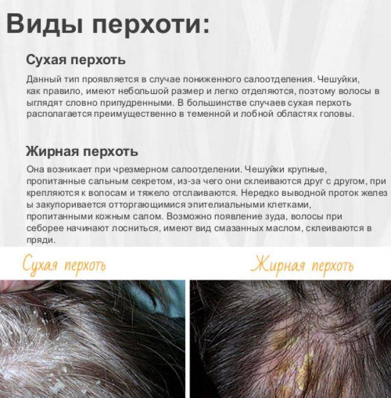 Лечение себорейного дерматита волосистой части головы: избавление от причин и симптомов