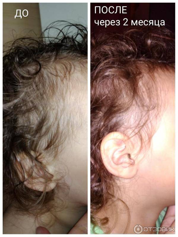 Выпадение волос у детей: причины и методы лечения