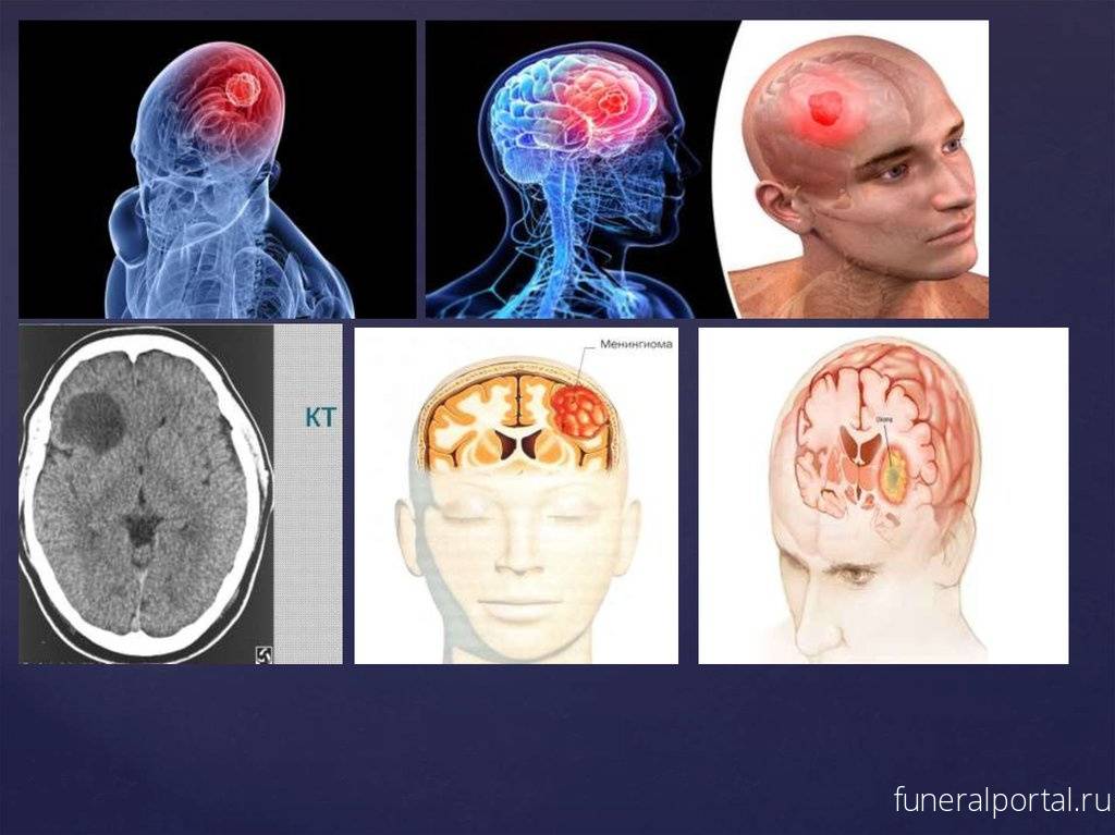 Причины возникновения опухолей головного мозга: генетические нарушения и другие причины возникновения различных видов новообразований
