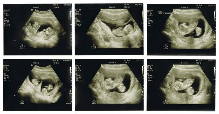 Почему рождаются близнецы и причины многоплодной беременности