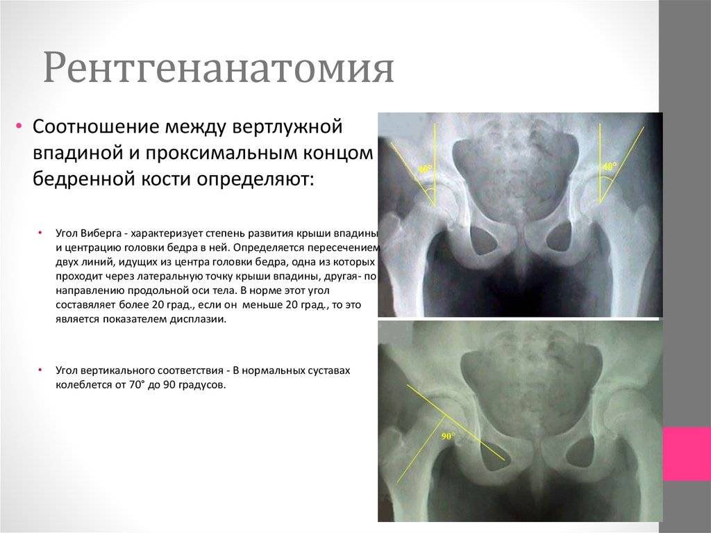Коксартроз (остеоартроз тазобедренного сустава) и его лечение