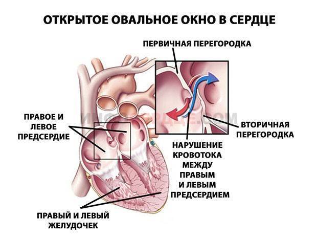 Открыто овальное окно у сердце ребенка