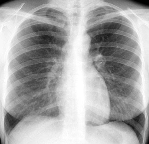 Рентген органов грудной клетки (огк), легких в москве — цены, адреса, телефоны