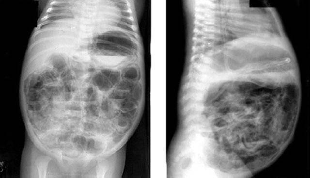 Morphological transformation of the intestinal wall in newborns with necrotising enterocolitis | karpova | russian journal of pediatric surgery, anesthesia and intensive care