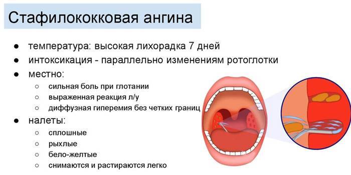 Тонзиллит – хронический и острый (инфекционное поражение небных миндалин). симптомы и лечение тонзиллита у детей и у взрослых.