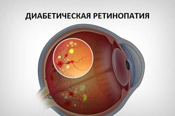 Ретинопатия недоношенных — википедия. что такое ретинопатия недоношенных