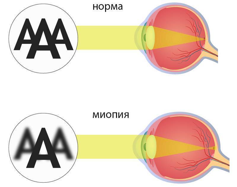 Что такое склеропластика глаз, какие есть “за” и “против” для выполнения операции детям?