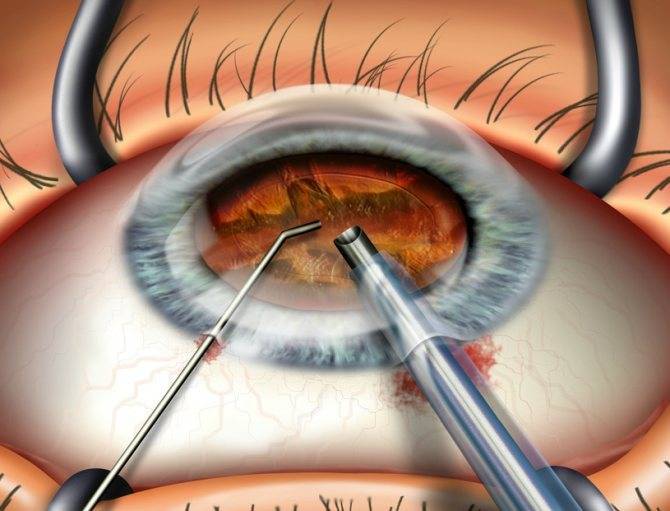Синдром сухого глаза в клинике микрохирургии глаза