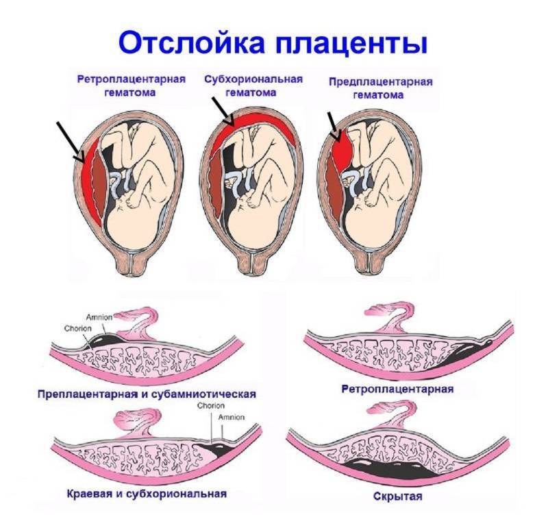 Что такое плацента - причины, диагностика и лечение