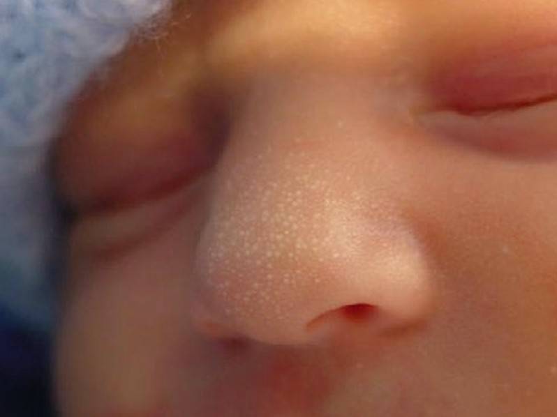 Мозоль на губе у новорожденного: почему появляется новообразование на верхней и нижней, последствия для ребенка, фото