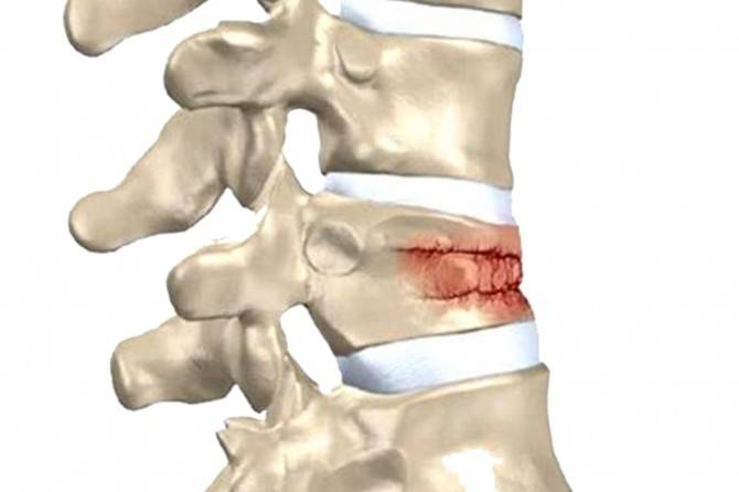 Компрессионный перелом позвоночника у детей: симптомы, лечение