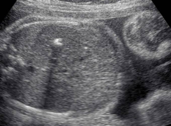 Патологии почек у плода: что и когда показывает экспертное узи при беременности * клиника диана в санкт-петербурге