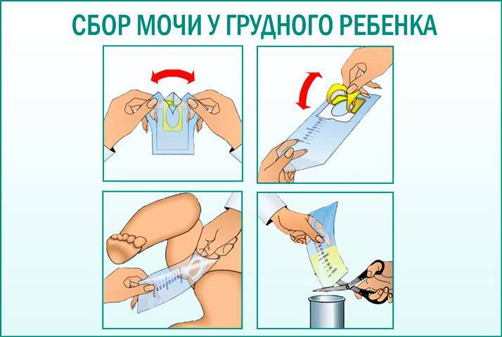 Биохимия мочи: проба сулковича