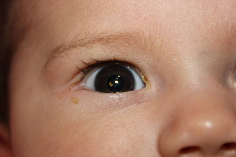 Воспалился глаз у ребенка - как и чем лечить