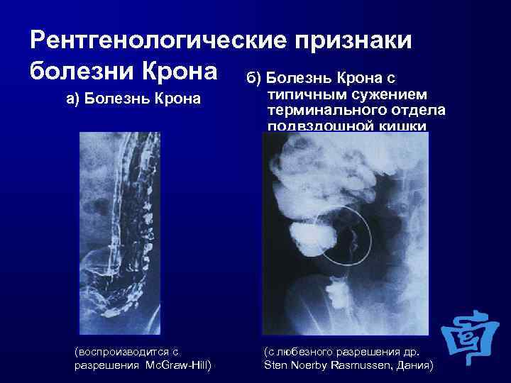 Болезнь крона: классификация, диагностика и лечение : lifekorea.ru