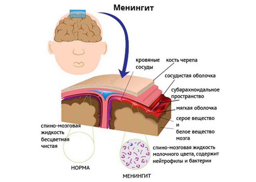 Хронический менингит - симптомы болезни, профилактика и лечение хронического менингита, причины заболевания и его диагностика на eurolab
