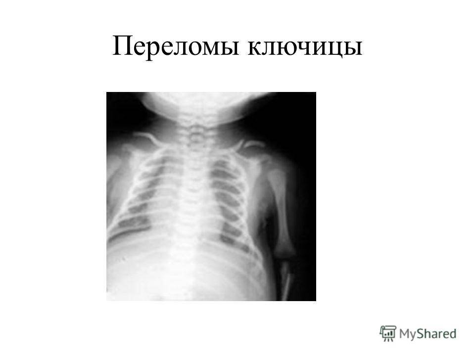 Перелом ключицы во время родов. Перелом ключится у детей. Перелом ключицы у новорожденных.