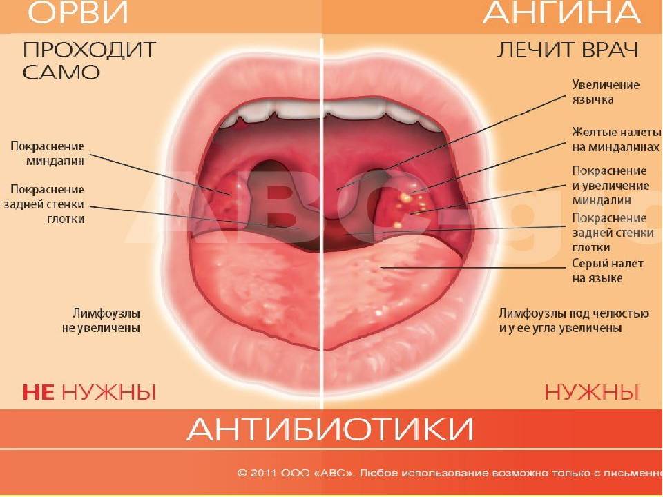 Увеличенные миндалины у ребенка - о чем свидетельствуют?