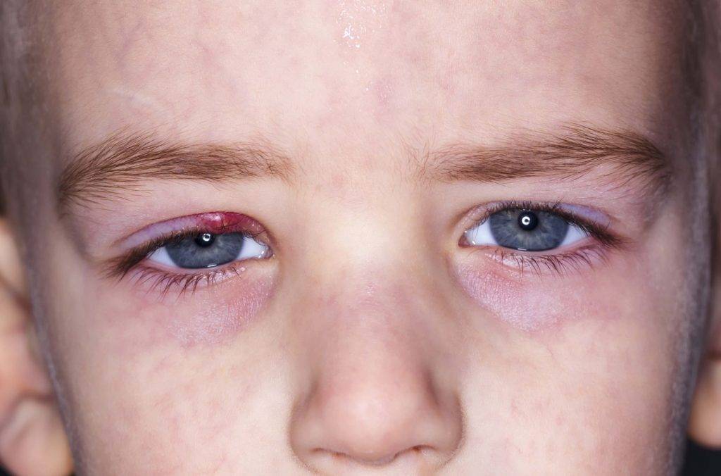 10 советов родителям при аллергическом конъюнктивите у ребёнка