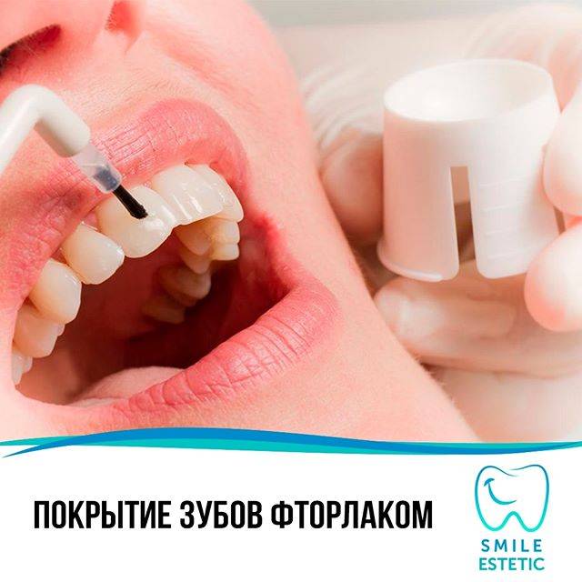 Фторирование зубов: цены в стоматологической клинике доктор мартин в москве