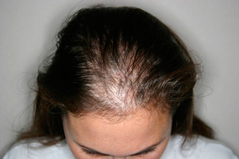 Выпадение волос у женщин – причины, лечение сильного выпадения