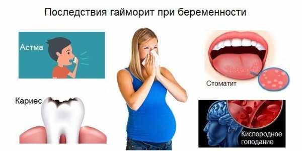Лечение синусита при беременности