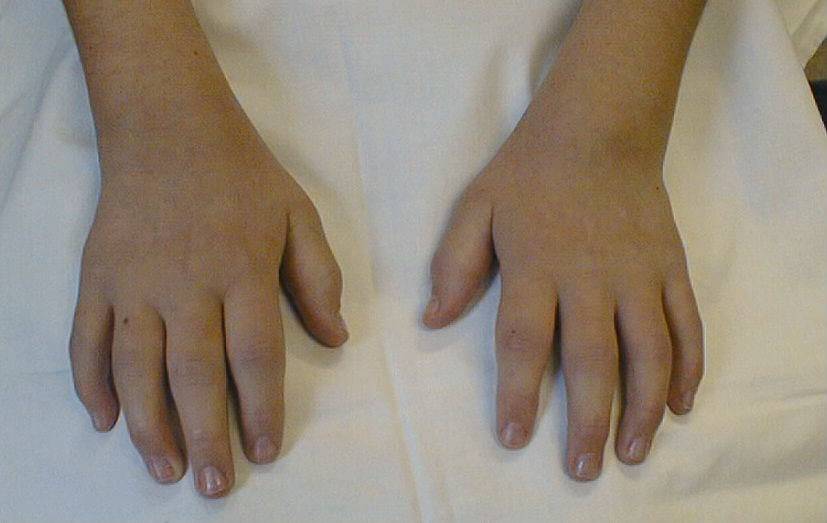 Ревматоидный артрит у детей: лечение в германии ювенильного артрита