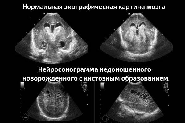 Нейросонография новорожденных, нсг, узи головного мозга