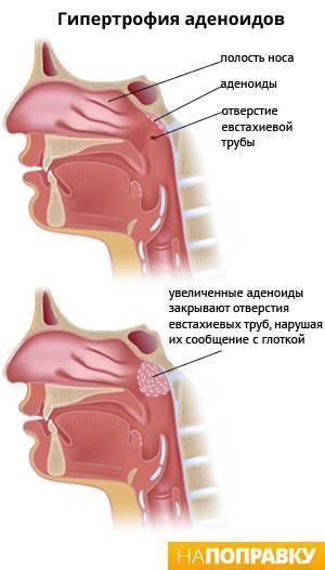 Лечение аденоидов без операции, лазерное безоперационное лечение аденоидов в носу у взрослых