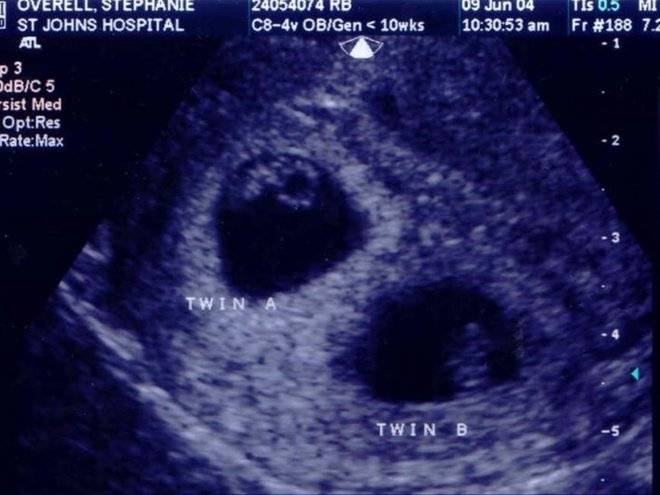 Скрининг 1 триместра беременности: сроки проведения и результаты