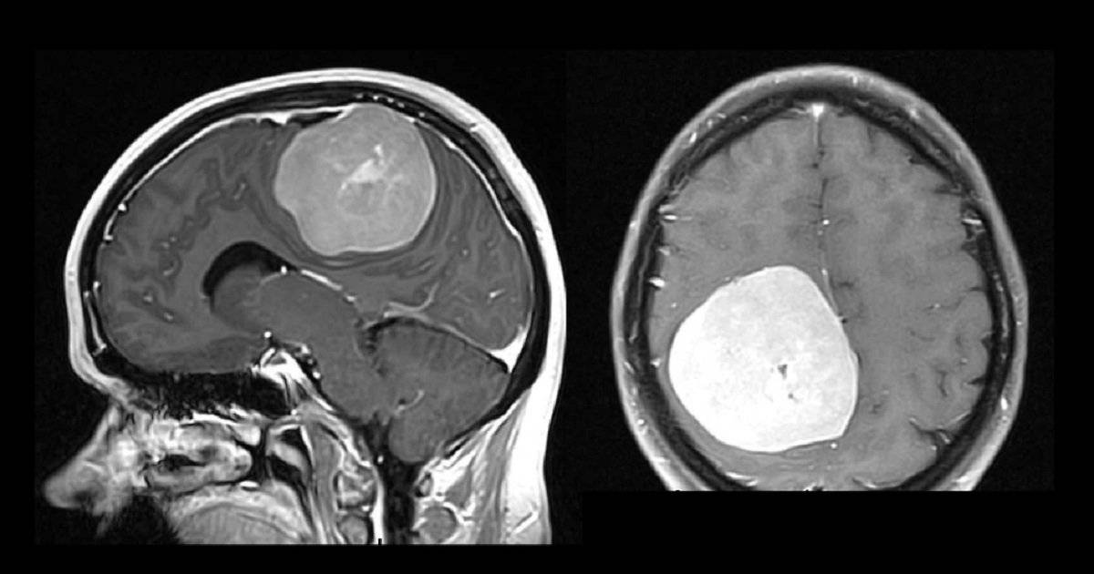 Опухоль ствола головного мозга: симптомы, лечение, профилактика — онлайн-диагностика