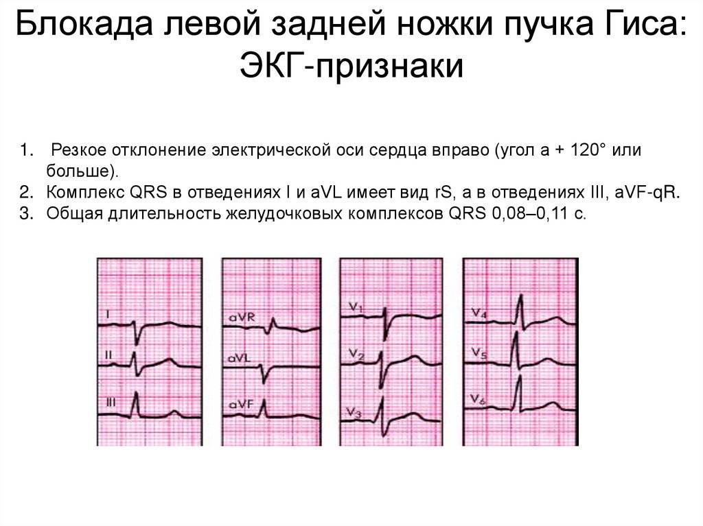 Левая и правая блокада пучка гиса. Блокада левой ножки пучка Гиса на ЭКГ. ЭКГ блокада левой ножки пучка. ЭКГ признаки блокады левой ножки пучка. Неполная блокада левой ножки пучка Гиса на ЭКГ.