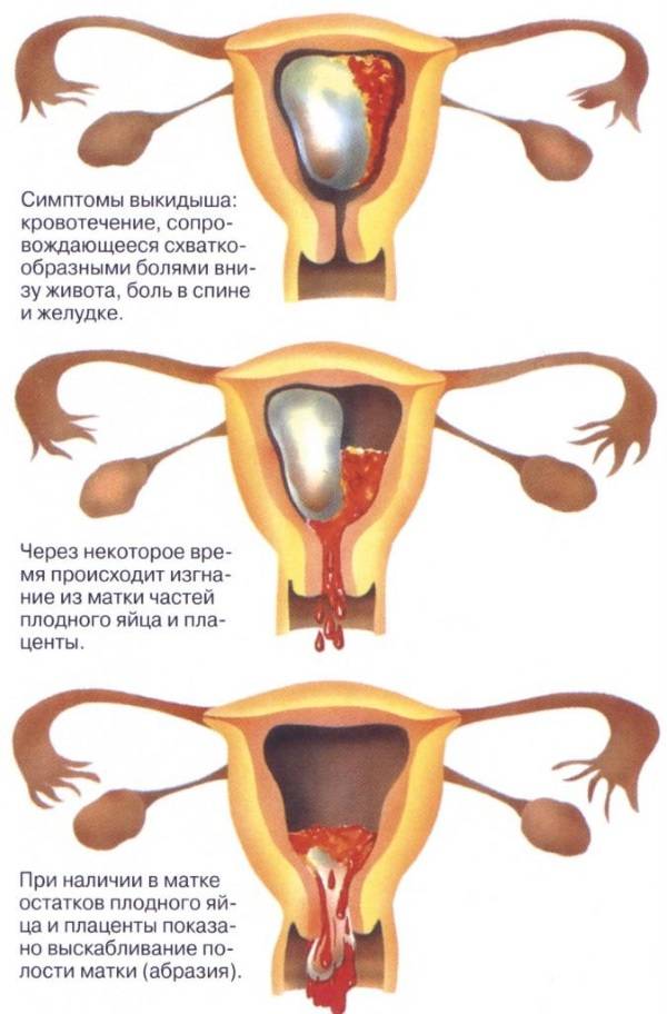 Могут ли при беременности на ранних сроках идти месячные? признаки и как отличить от обычной менструации