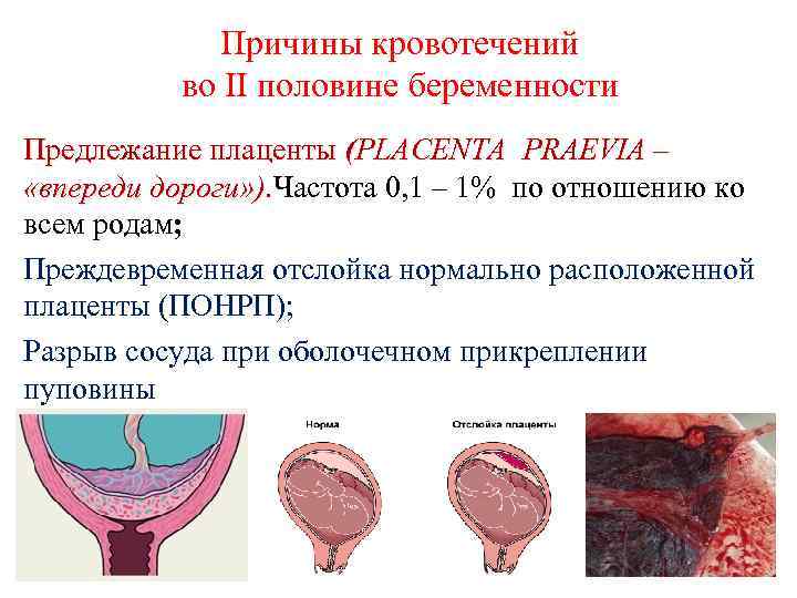Имплантационное кровотечение во время ранней беременности