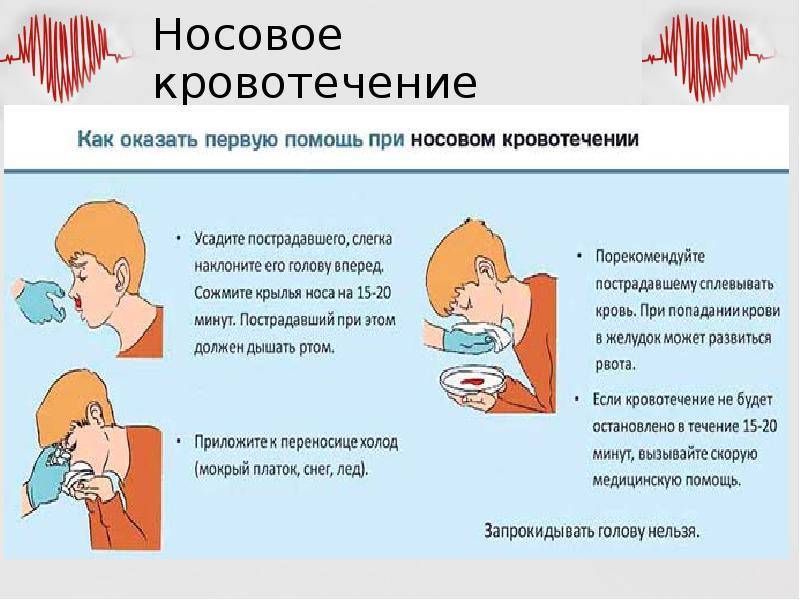 Носовое кровотечение: почему оно возникает и как устранить причины?