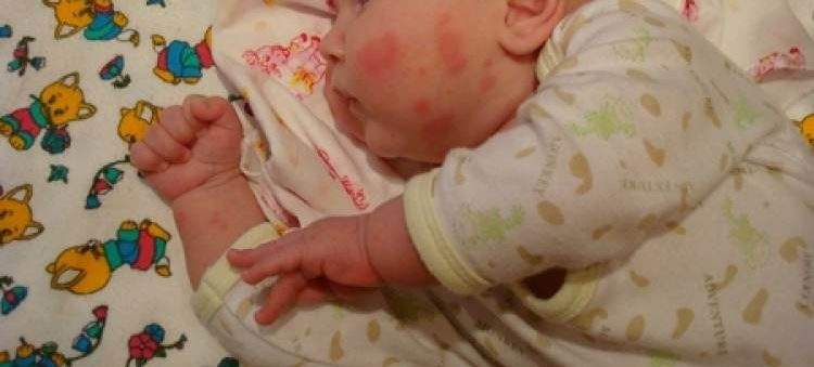Аллергия на молоко у детей: причины покраснения и зуда кожи