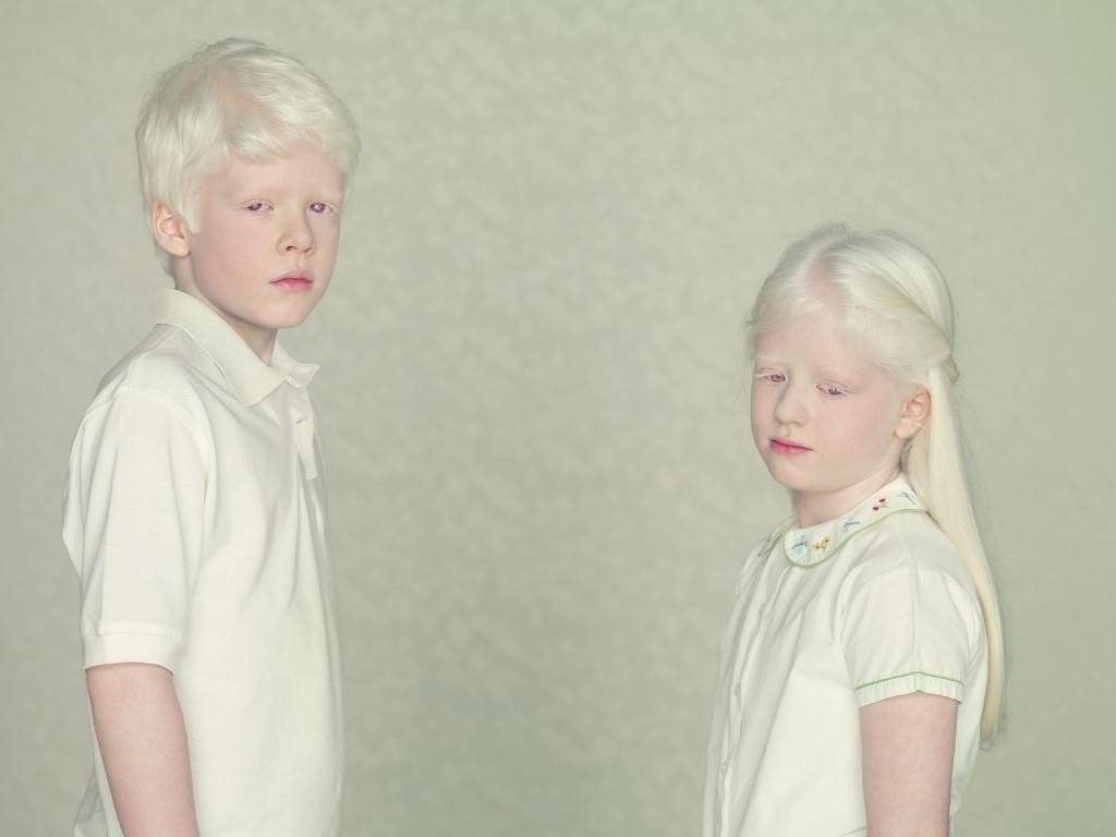 Сообщество пациентов с альбинизмом. форум пациентов с альбинизмом