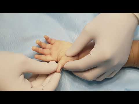 Безоперационное лечение щелкающего пальца (болезнь нотта) - estetik international | aesthetic plastic surgery estetik international | aesthetic plastic surgery