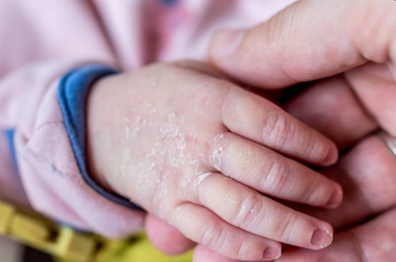 Болезни кожи у новорождённых: 7 различных проявлений