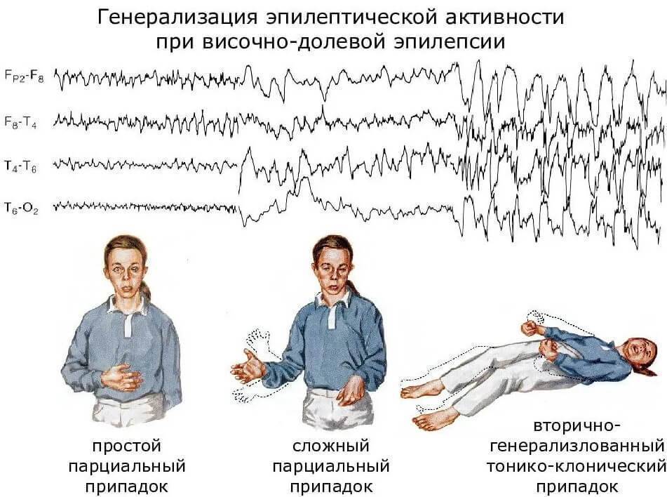Фокальная эпилепсия у детей - лечение, причины, симптомы, прогноз