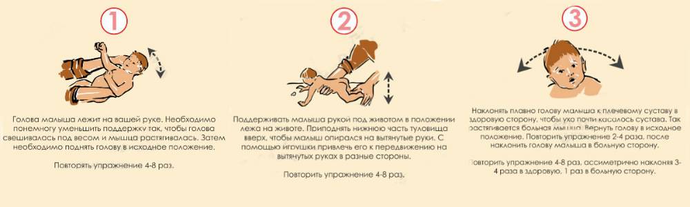 Профилактический и лечебный массаж ребенку при кривошее