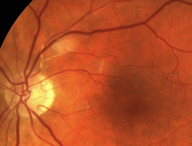 Задняя агрессивная ретинопатия у недоношенных младенцев