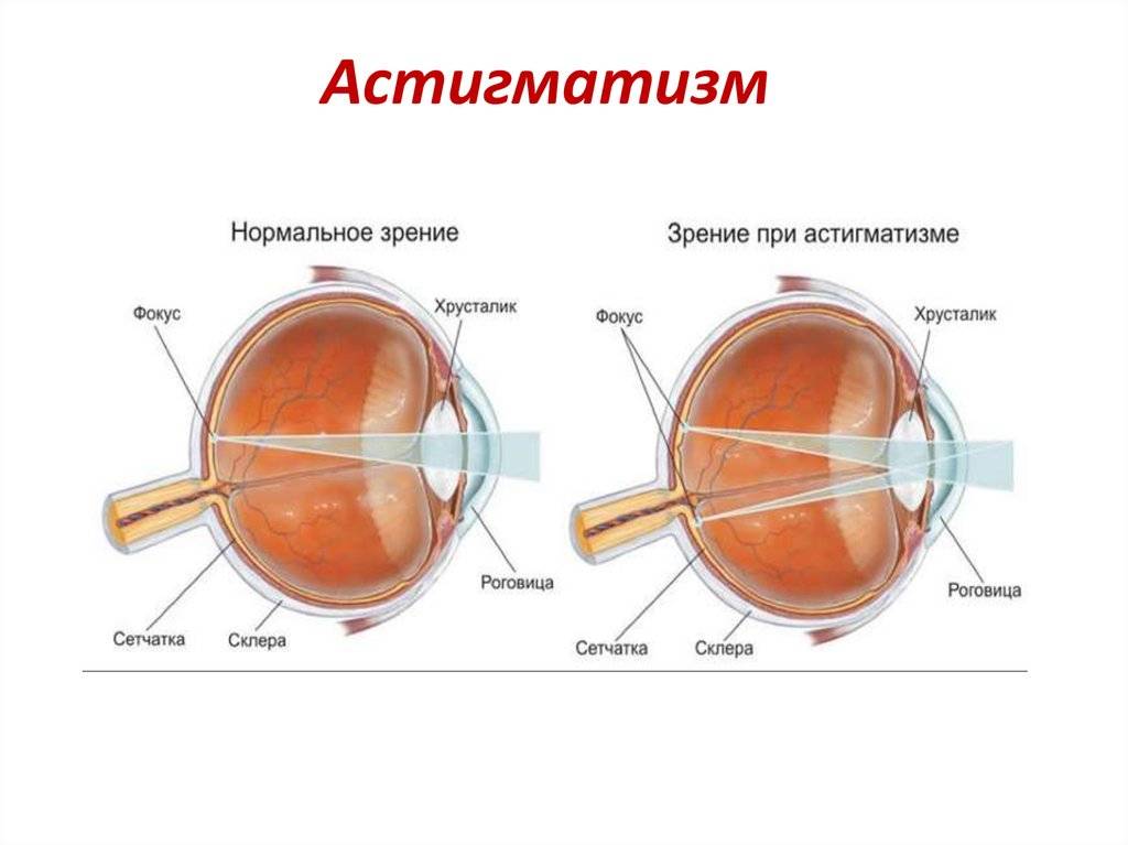 Упражнения для укрепления мышц глаз при астигматизме - энциклопедия ochkov.net