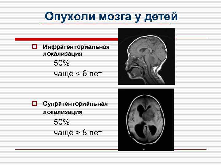 Симптомы опухоли головного мозга на ранних стадиях, первые признаки рака головного мозга